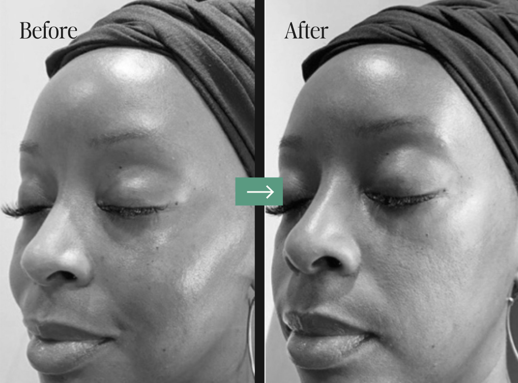 Botox Before and After Pictures Charleston, SC